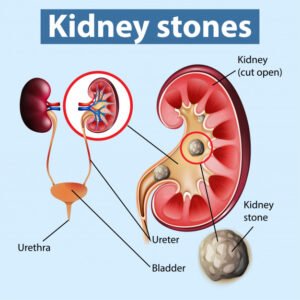 adrenal gland kidney stones adrenal gland kidney stones