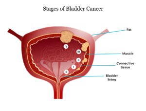 Bladder cancer specialist in Lucknow- Most effective treatment with Dr ...