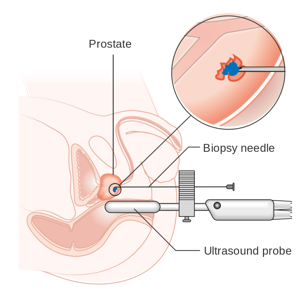 Diagram showing a transperineal prostate biopsy CRUK 473.svg