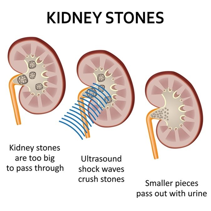 Phimosis - Cure Stone - Urology, Andrology, Renal Transplant