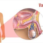varicocelectomy