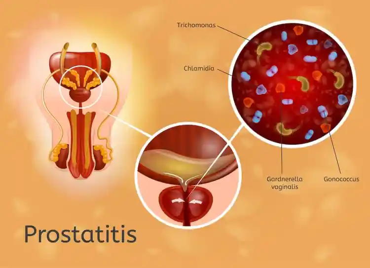Bacterial Prostatitis