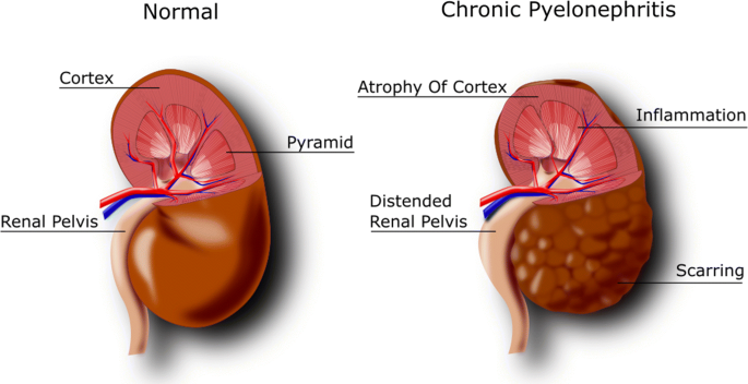 chronic kidney disease 
