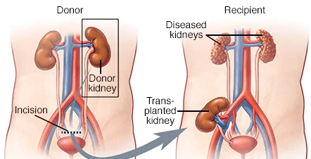 Is Kidney Transplant Costly ?