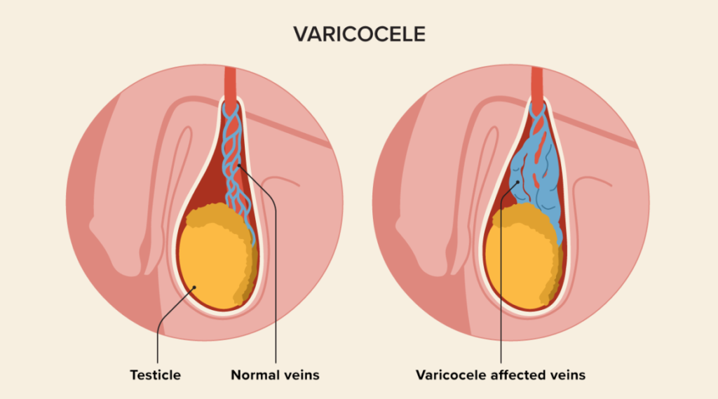 1884335 Varicocele.20220125174126722