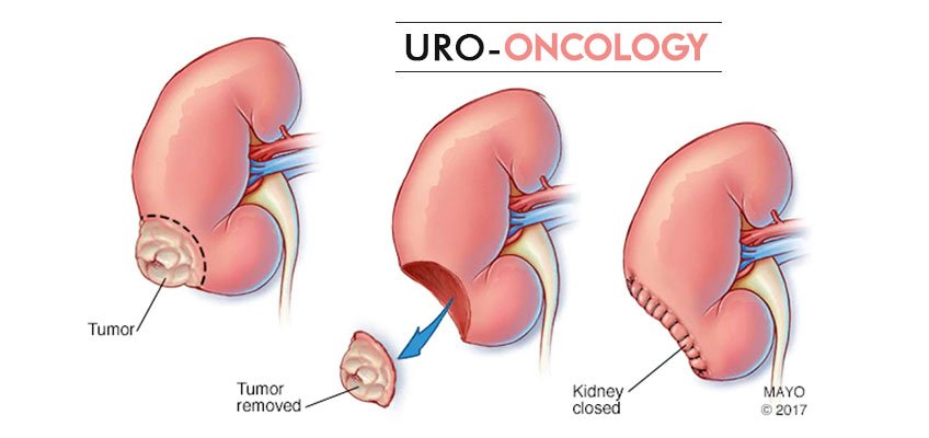 Urological Oncology