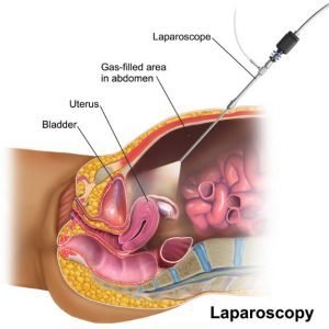 laparoscopy 300x300 1