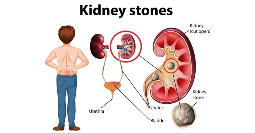 Kidney Stones Cure Themselves