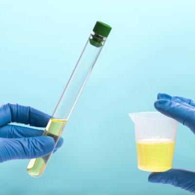 urine analysis laboratory 96336 1417